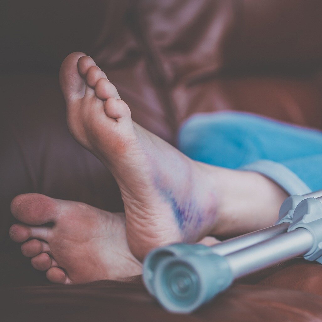 Case Study: Successful Claim for Client After Fall in Unsafe Hotel Grounds.