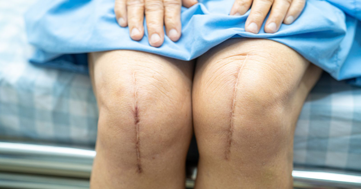 Knee, Hip or Joint Replacement Surgery that didn’t go to plan?